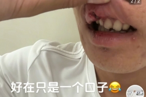 玉昆后卫晒受伤照：提前换下因争头球撞到了 视野模糊看不清&头晕
