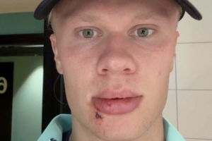 倒霉！哈兰德社媒晒自拍：被公交车门撞了，缝了3针&看起来还挺好