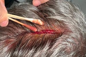 被恩加德乌误伤！国安翻译晒塞蒂恩伤口：经队医处理已无大碍