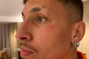 记者：克雷桑头部被踢了一下，换下他是用了脑震荡条款